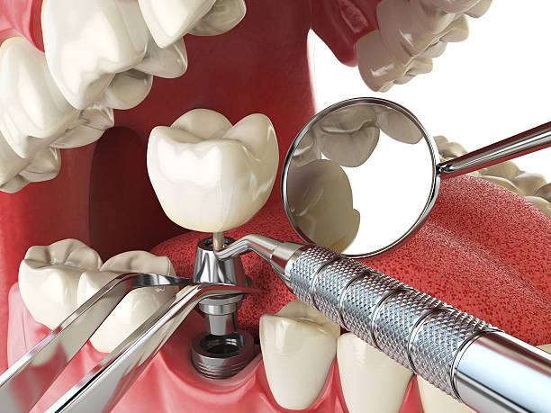 Best Emergency Treatment for Dental Infections or Abscesses in Fairmount, NY